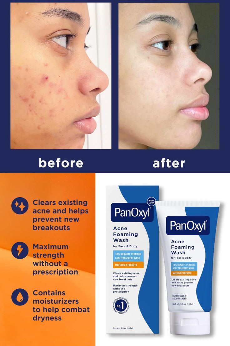 PanOxyl – Acne Foaming Wash 10% Benzoyl Peroxide (Maximum Strength)