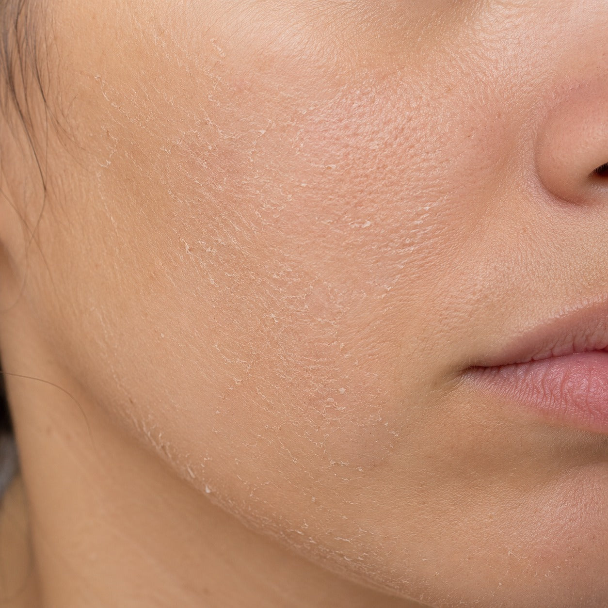 Dry & Dehydrated Skin