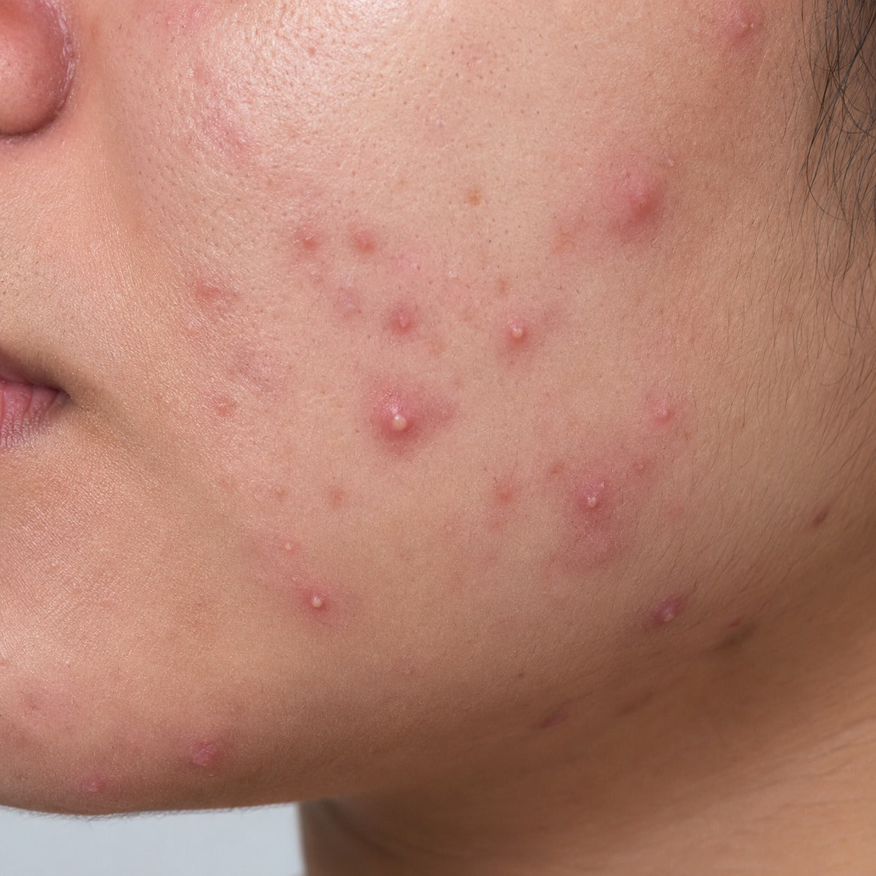 Acne-Prone Skin