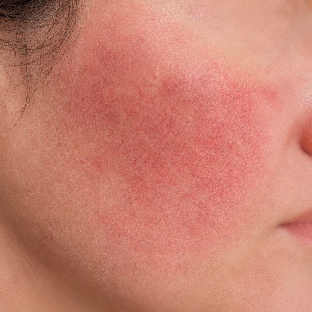 Sensitive & Rosacea-Prone