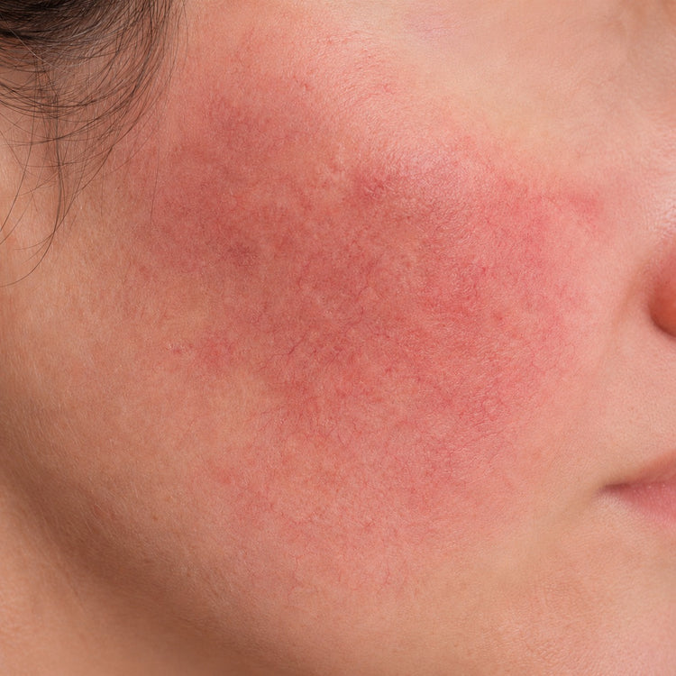 Sensitive & Rosacea-Prone