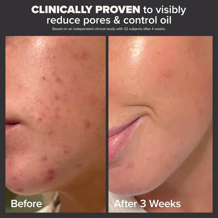PAULA’S CHOICE Skin Perfecting 2% BHA Liquid Exfoliant (118ml)